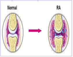 Rheumatoid arthritis(류마티스 관절염)